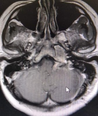 Post_condrosarcoma_02