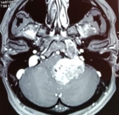 condrosarcoma_01